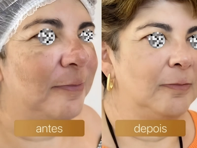 Antes e depois — resultado de aluna FOCOS
