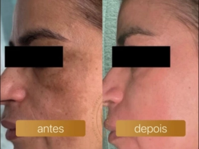 Antes e depois — resultado de aluna FOCOS