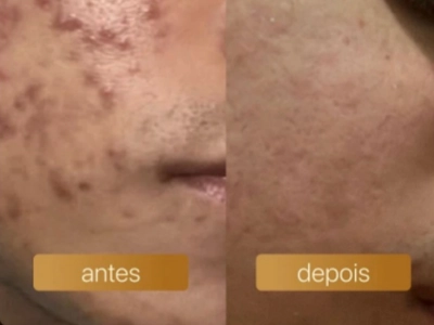 Antes e depois — resultado de aluna FOCOS