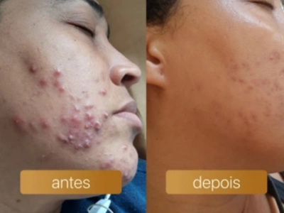Antes e depois — resultado de aluna FOCOS