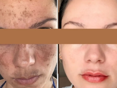 Antes e depois — resultado de aluna FOCOS